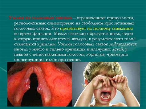 Последствия голосовой афонии на связки