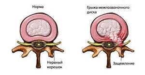 Признаки и симптомы защемления нерва на спине
