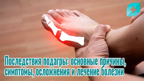 Причины возникновения подагры