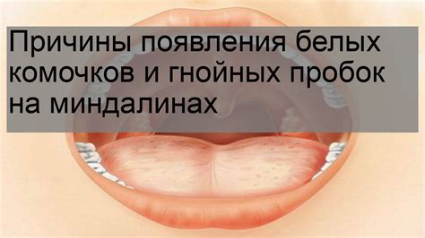 Причины и симптомы белых точек на миндалинах