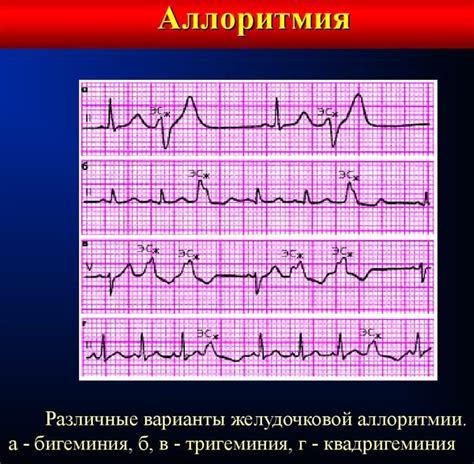 Причины наджелудочковой экстрасистолии