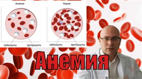 Причины снижения гемоглобина