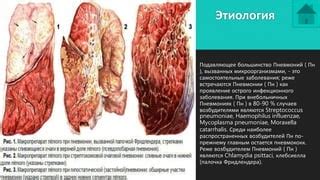 Проявление недостатка воздуха при пневмонии