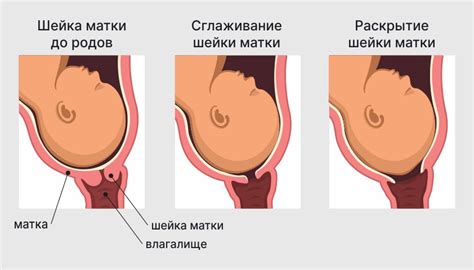 Раскрытие шейки матки
