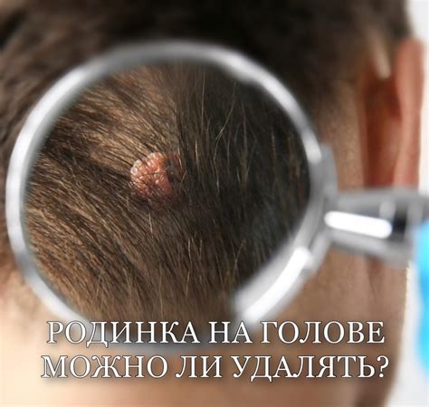 Рекомендации перед удалением родинок
