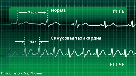 Рекомендации по занятию танцами при наличии тахикардии