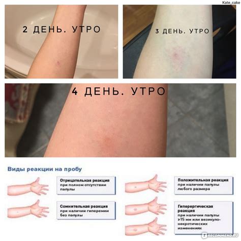 Рекомендуемая диета после диаскин-теста