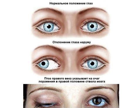 Симптомы двоения в глазах
