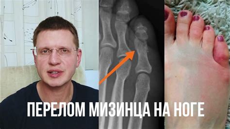 Симптомы перелома мизинца на ноге