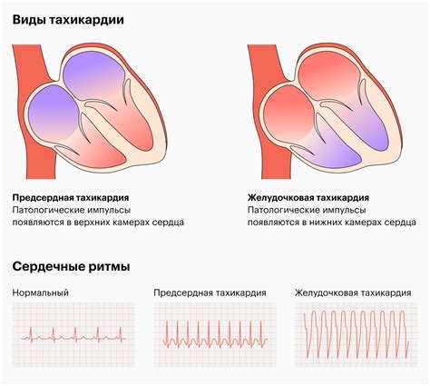 Танцы как способ активного движения при тахикардии