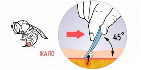 Удаление жала и обработка укуса