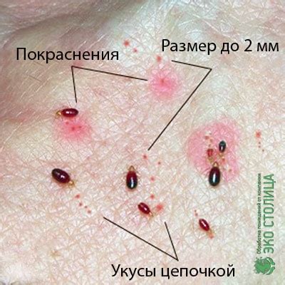 Укус клопа: что делать при появлении первых симптомов