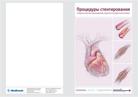 Ход процедуры стентирования