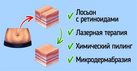 Что такое растяжки и почему они возникают