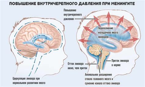 Эффекты внутричерепного давления на организм