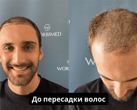  Процесс пересадки 