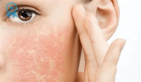 Аллергическая реакция на косметику