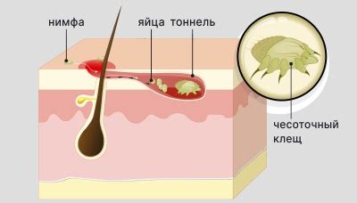 Аналогия с чесоткой