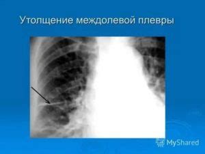 Важность междолевой плевры справа