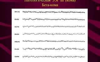 Возможные последствия дезорганизованной активности ЭЭГ и лечение