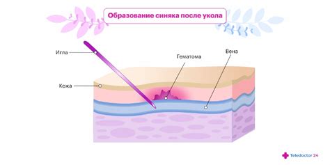 Действия в случае заражения после укола иглой при шитье