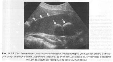 Диагностика высыхания желчного пузыря