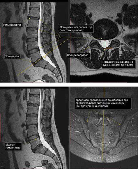 Диагностика дегенеративно-дистрофических изменений грудного отдела позвоночника