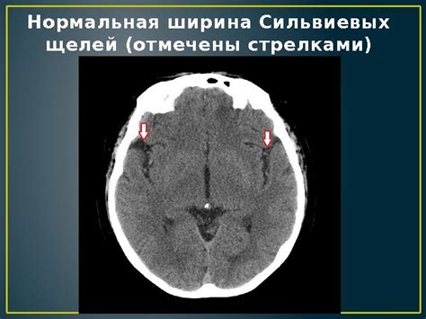 Диагностика расширения сильвиевых щелей