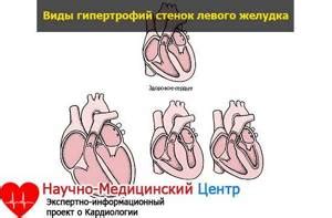 Диагностика удлинения дуги левого желудочка