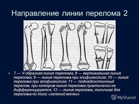 Диагностика частичного прослеживания линии перелома