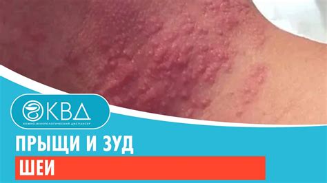 Лечение зуда на шее сзади