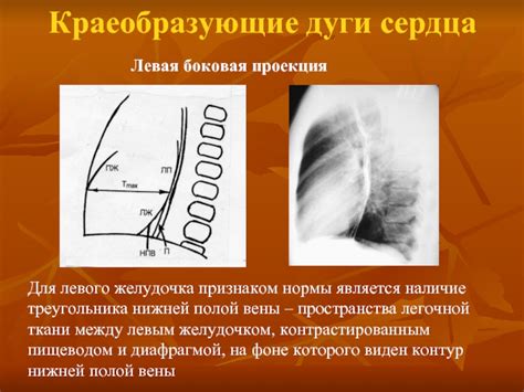 Лечение удлиненной дуги левого желудочка