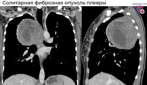 Лечение утолщения костальной плевры