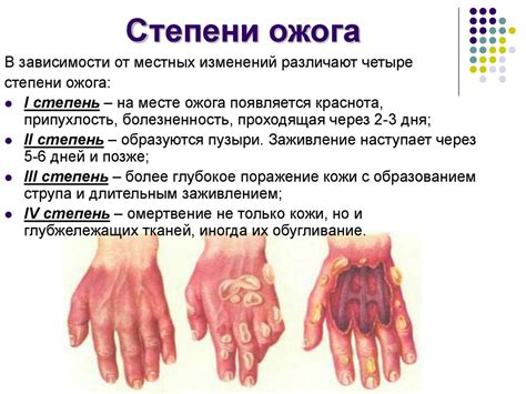 Ожог руки и его симптомы