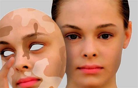 Пигментационные нарушения