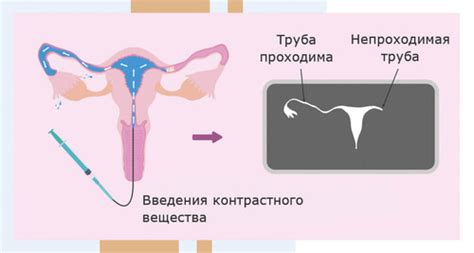 Причины возникновения извитости маточных труб
