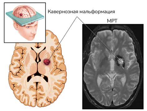 Причины расширения борозд мозжечка