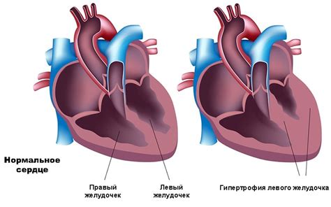 Причины удлинения дуги левого желудочка