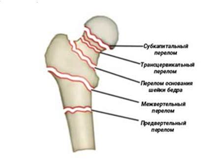Причины частичного прослеживания линии перелома