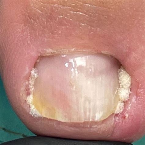 Профилактика перепиливания ногтя