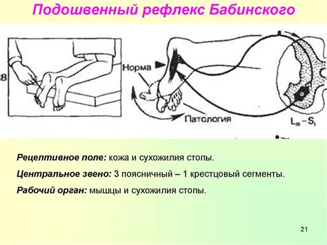Проявление симптома Бабинского справа