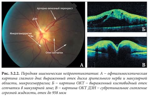 Раздел 1: Пигментация в макулярной зоне