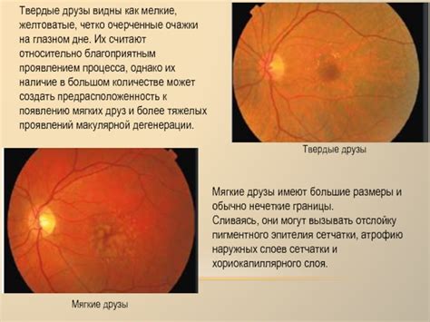 Раздел 2: Перераспределение пигмента в макулярной зоне