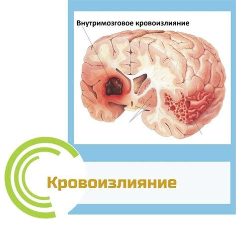 Роли бытовых повреждений в возникновении кровоизлияний