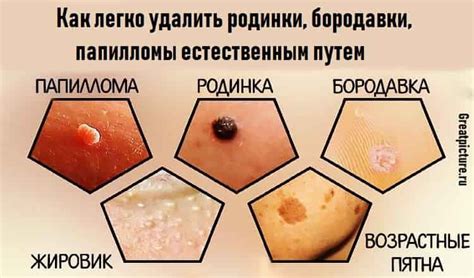 Секреты родинки сердцем