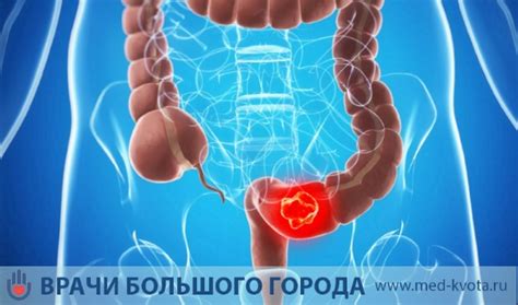 Симптомы и диагностика эпителиального образования прямой кишки