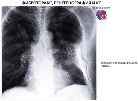 Симптомы утолщения костальной плевры