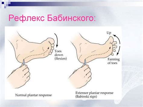 Симптом Бабинского