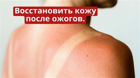 Солнечные ожоги и фотодерматиты