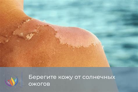 Солярий и солнечные ожоги